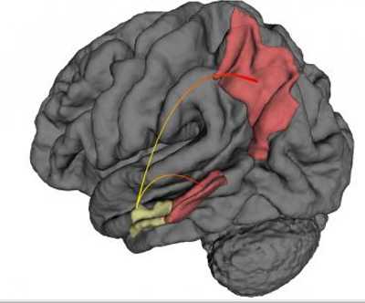 alzheimersbrain