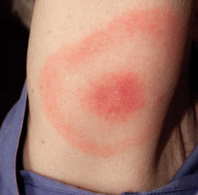 The bull's-eye rash that indicates the presence of Lyme disease. Courtesy photo. lymediseasebullseyerash